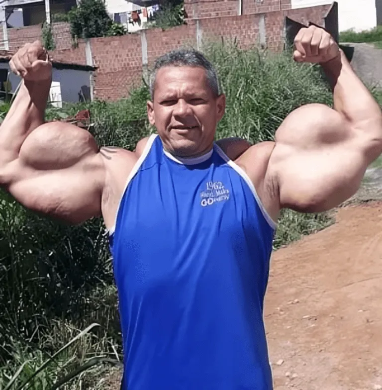 وفاة «باباي البرازيلي» بعد صراع صحي مرير.. حقن تضخيم العضلات تقود لاعب كمال الأجسام إلى النهاية (2)